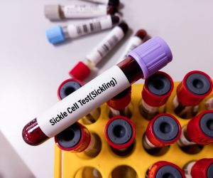 Blood sample for Sickling (sickle cell) Test. Sickle Cell disease blood test sample in doctor hand.